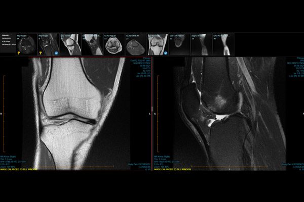 Evaluation of Joint/Extremity with MRI (Single site)
