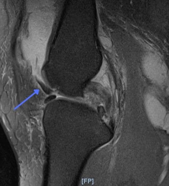 Journey of a Patient with a Bad Meniscus Tear in the Knee