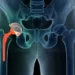 Prevent Dislocation after Hip replacement