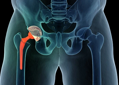 How To Prevent Dislocation After Hip Replacement