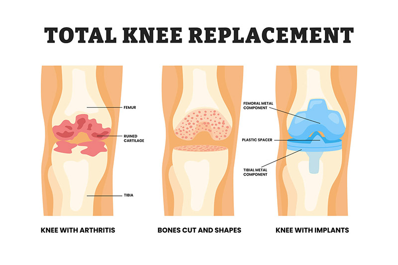 Total Knee Replacement Diagram