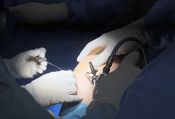 Knee Arthroscopy for Meniscus Repair